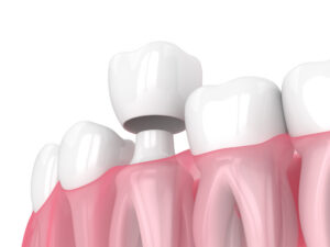 How to Make Your Dental Crown Last for Decades in Bentonville, AR